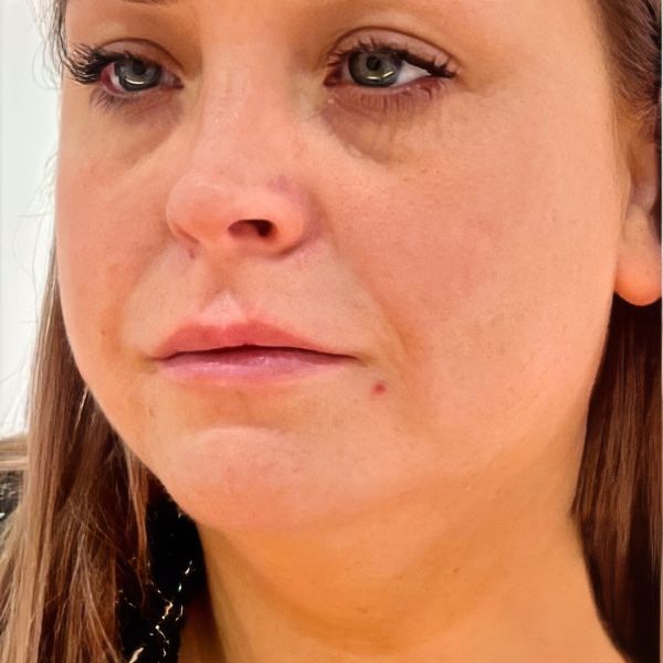 Before treatment - Patient 3